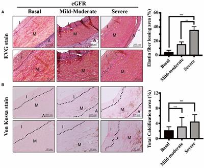 Uremic Vascular Calcification Is Correlated With Oxidative Elastic Lamina Injury, Contractile Smooth Muscle Cell Loss, Osteogenesis, and Apoptosis: The Human Pathobiological Evidence